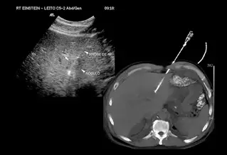 Cryoablation