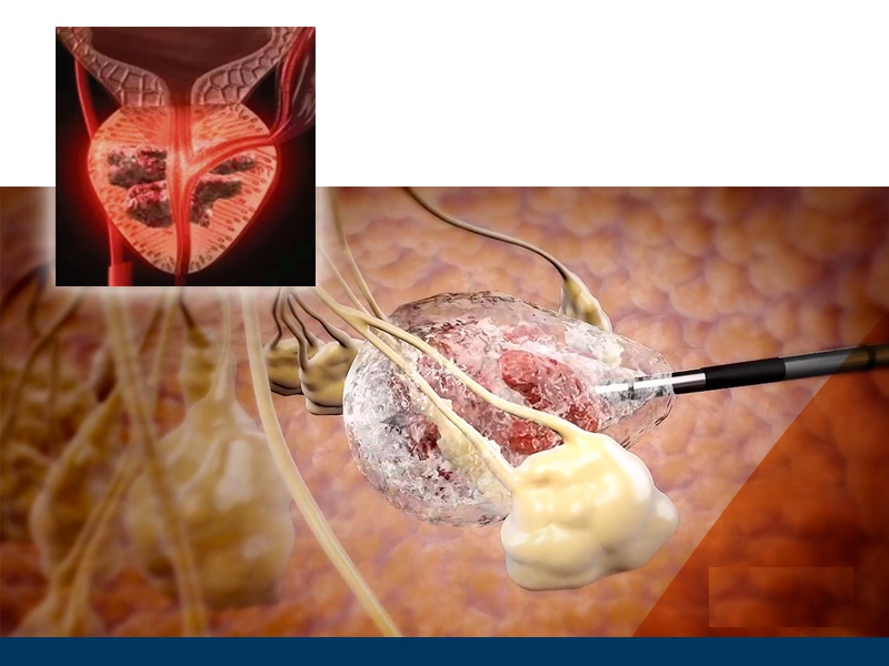 Cryoablation