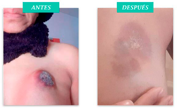 toxina de Coley